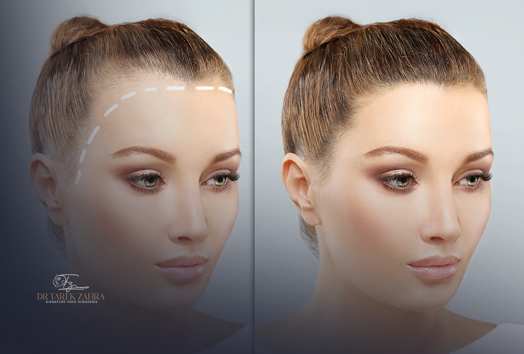 Forehead-Reduction-Surgery