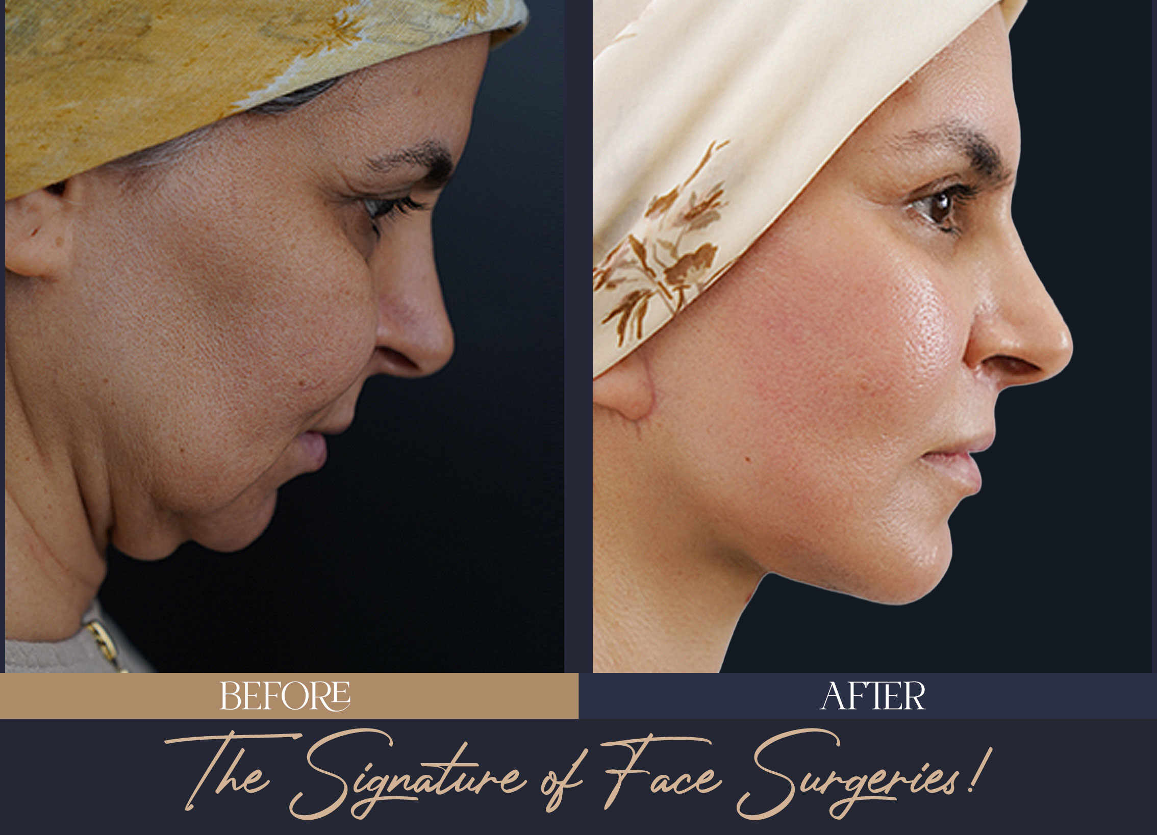 Highlighting-Facial-Beauty-with-the-5D-Facelift