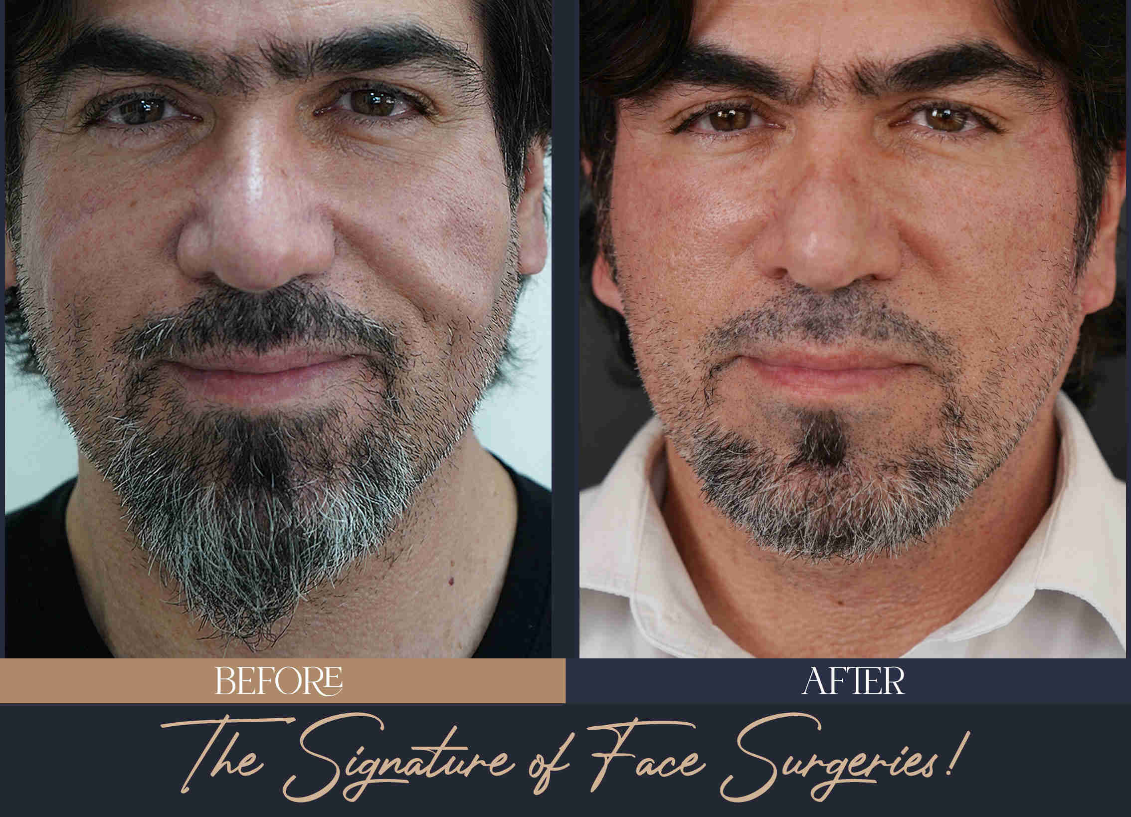 Permanent-Filler-Removal-with-Extended-Deep-Facelift-and-Reconstruction