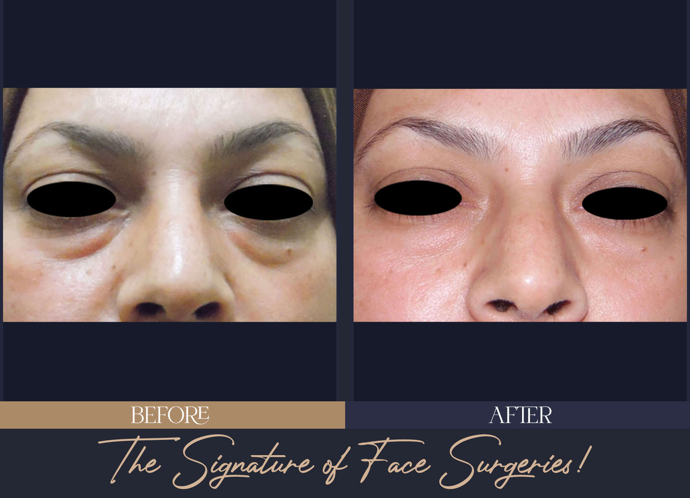 Restoring-Eye-Beauty-with-Lower-Eyelid-Surgery